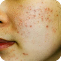 ニキビ跡の赤み